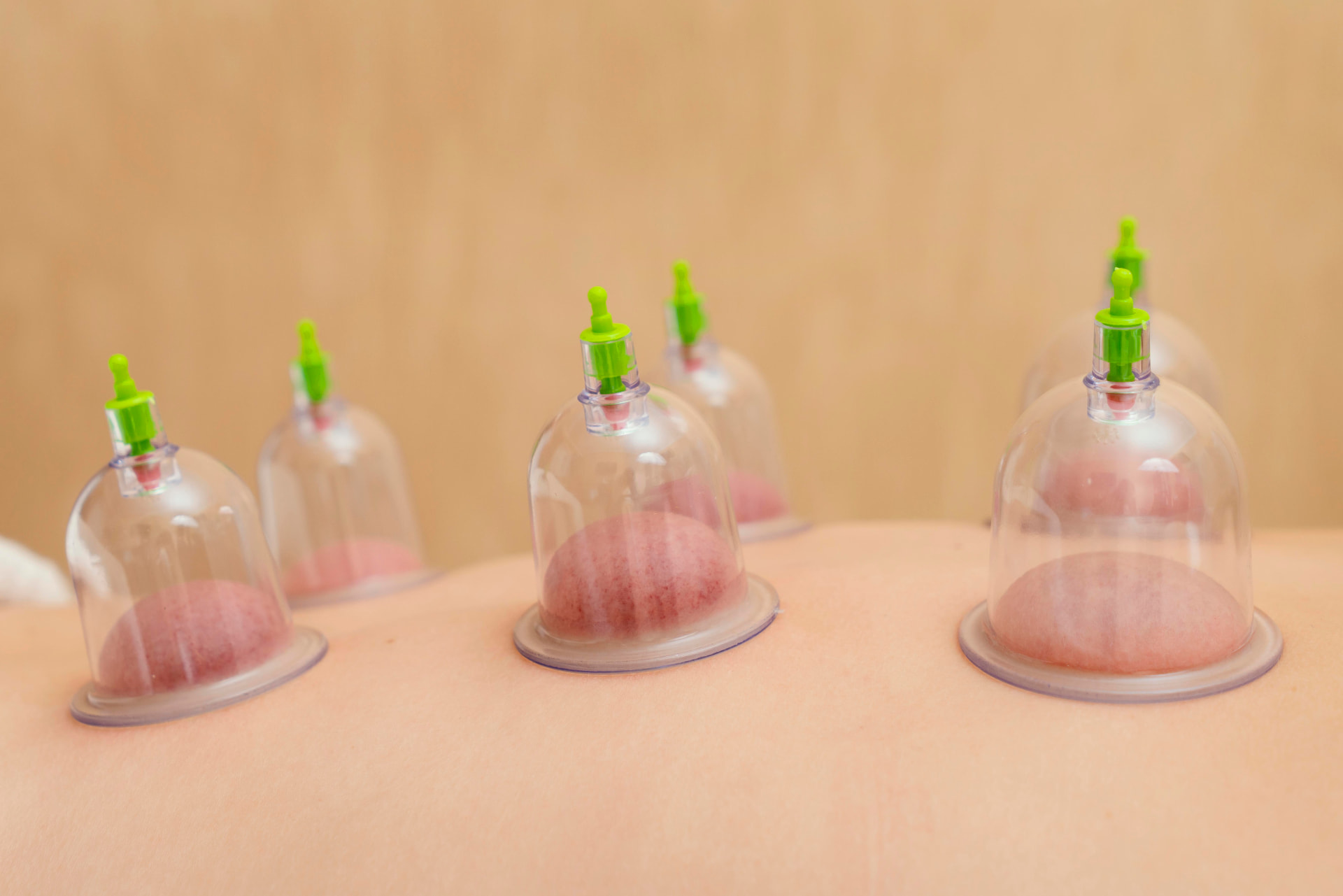 Hijama cupping therapy session